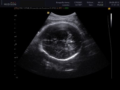 Corte Tranverso Cabeza Fetal. Diametro biparietal